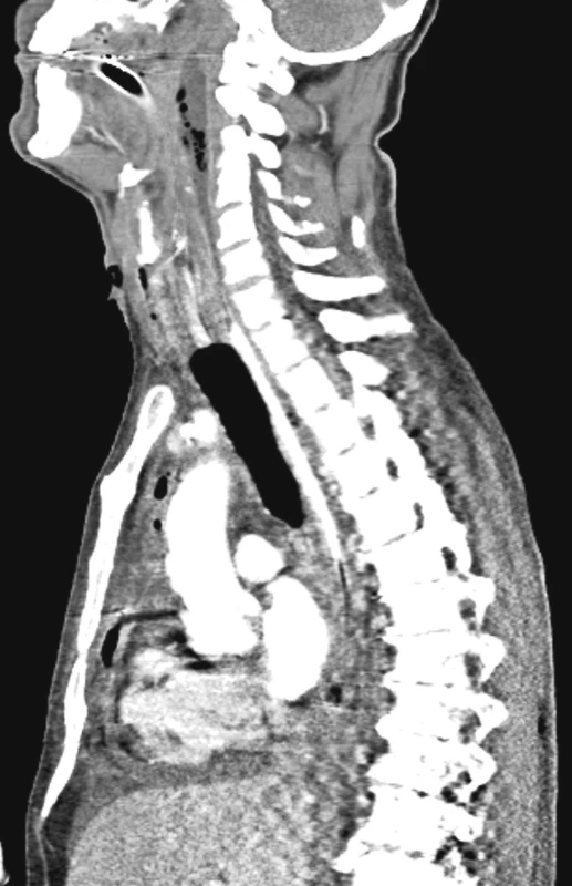 Sagitální rekonstrukce ukazující rozsah prevertebrálního abscesu v kraniokaudálním směru
Fig. 4. Saggital reconstruction showing the cranio-caudal extent of the prevertebral abscess