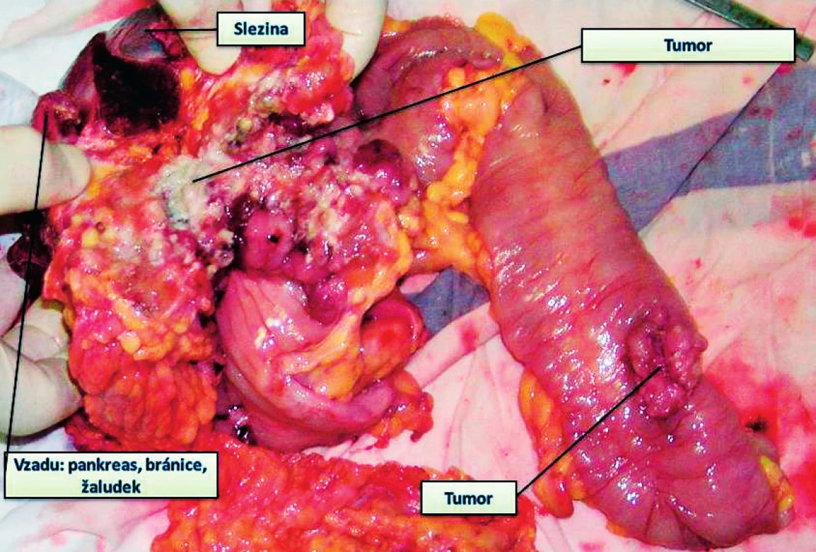 Nádor příčného tračníku prorůstající do bránice, žaludku, kaudy pankreatu, současně další nádor na tračníku – provedena multiorgánová resekce