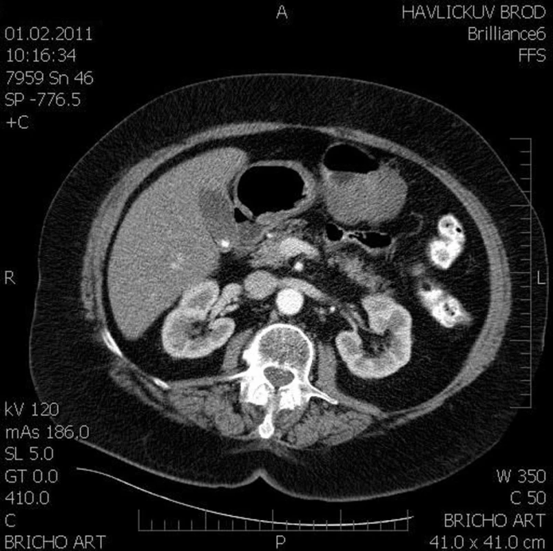 CT obraz, dle popisu exofyticky rostoucí tumor žaludku
Fig. 1: Abdominal CT, the findings described as a gastric tumor with exophytic proliferation