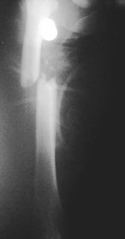Úrazové RTG zlomeniny diafýzy stehenní kosti – foceno ve vakuové dlaze
Pic. 1. X-ray of diaphyseal femur fracture – x-rayed in a vacuum cast