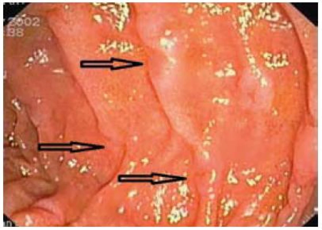 Sliznice duodena s několika erozemi a „vykousnutím“ řas (šipky) – typický obraz Crohnovy choroby v duodenu.