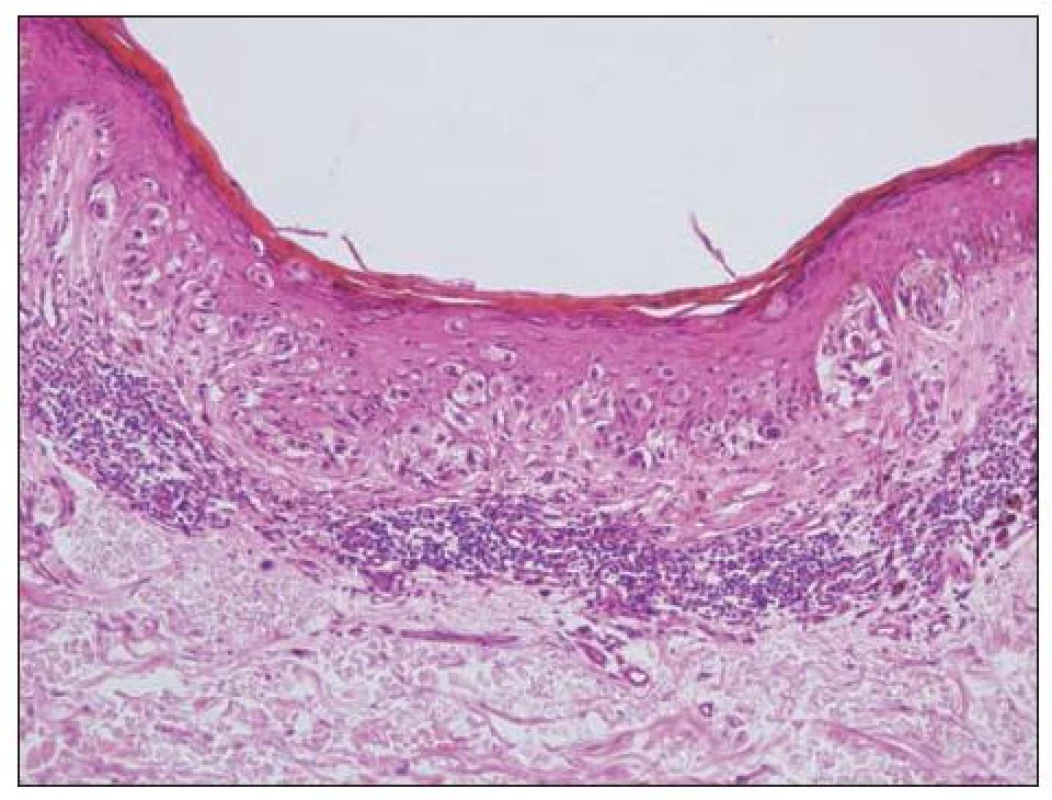 Melanoma in situ – asymetrické rozložení hnízd i jednotlivých melanocytů v epidermis, melanocyt v horních vrstvách, pleomorfismus buněk