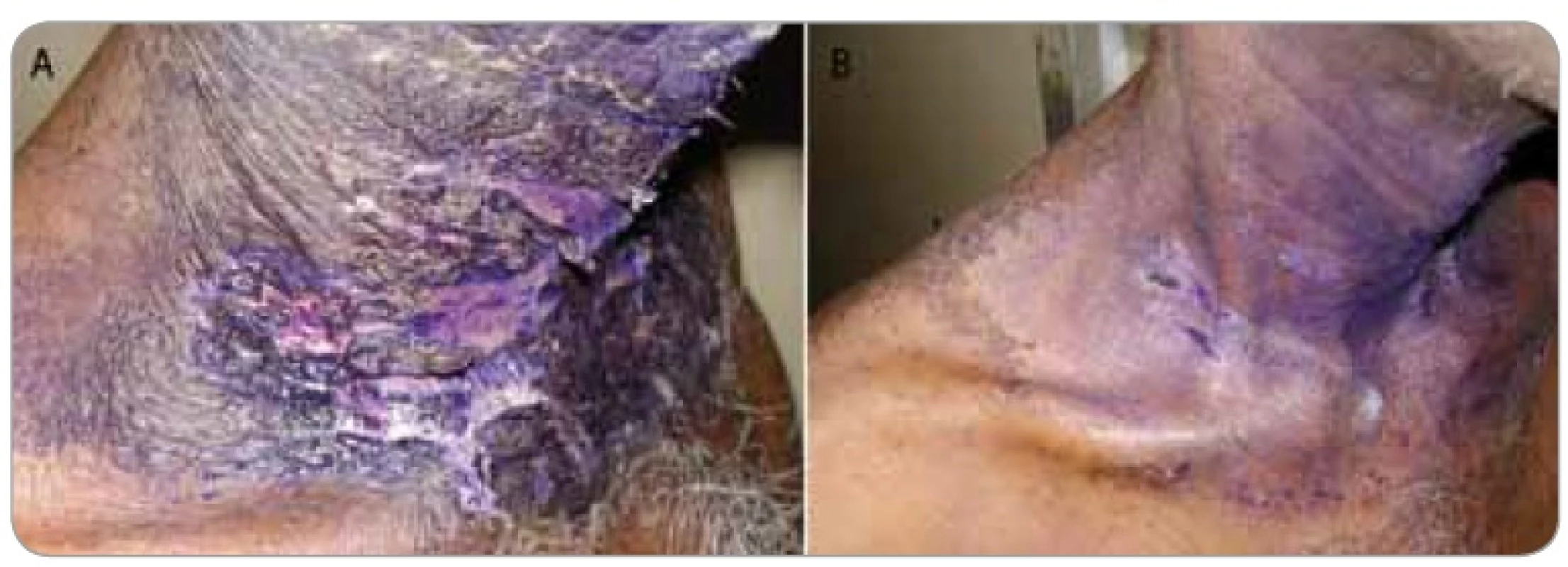 Fig. 3A shows a 55-year-old male on treatment with external radiotherapy for a head and neck malignancy with grade III moist desquamation that had developed in the 5th week of treatment and was treated with GV paint for 1 week without any response and the wet skin moist desquamtion persisted and the patient was referred to us for cytokine therapy. Fig. 3B shows the same patient with remarkable resolution of lesion by day 5 after a single dose of GCSF injection. He was able to reassume radiotherapy within a week.