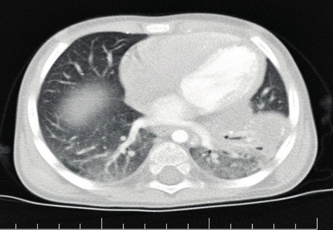 Pneumonický infiltrát v dolnom laloku vľavo.
Fig. 2. Pneumonic infiltrate in inferior lobe l. sin.
