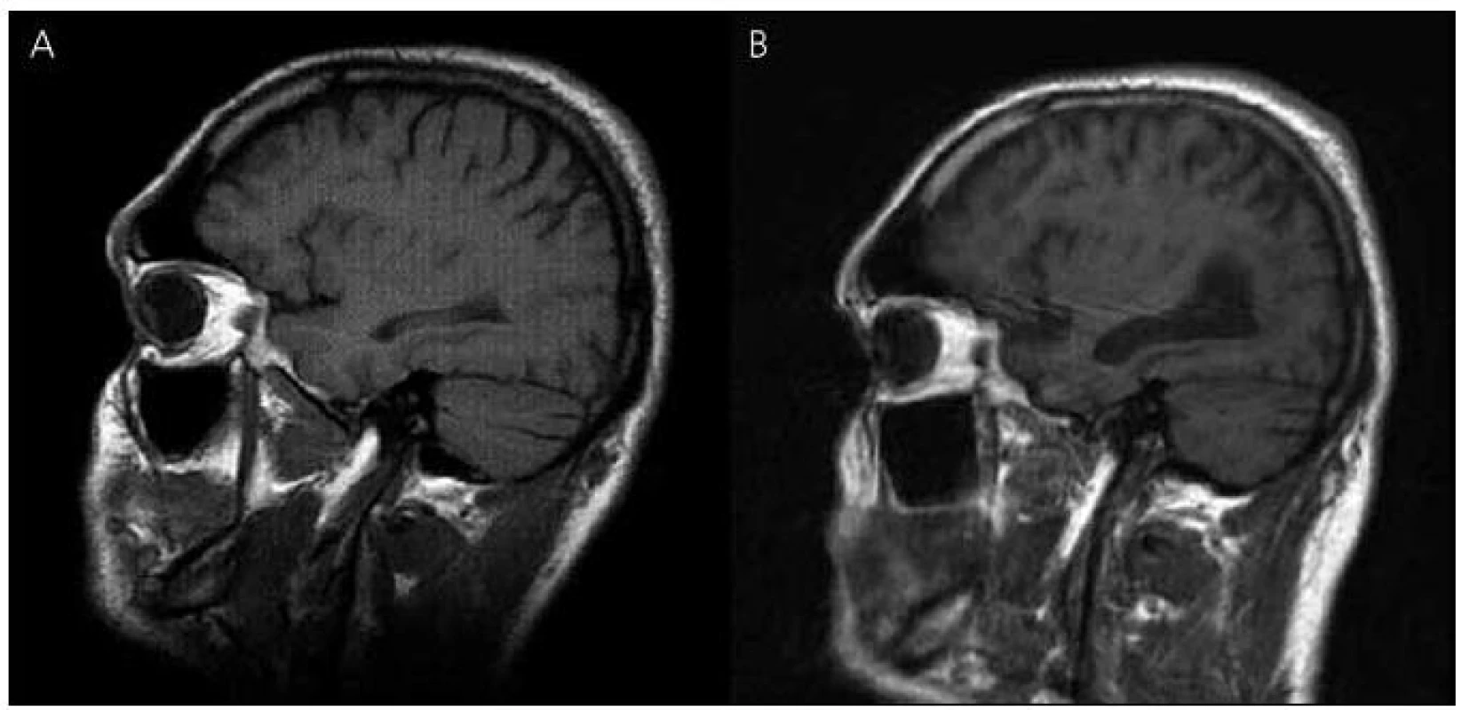 Magnetická rezonance mozku pacienta IV-7.
Sagitální řezy v T1 vážených obrazech – vývoj atrofie: (A) rok 2003, (B) rok 2010.