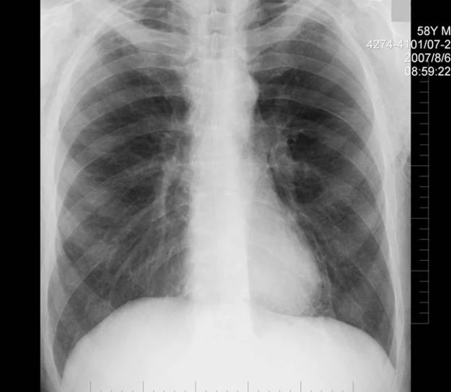 RTG plic po týdnu
Fig. 8. Chest X-ray after a week