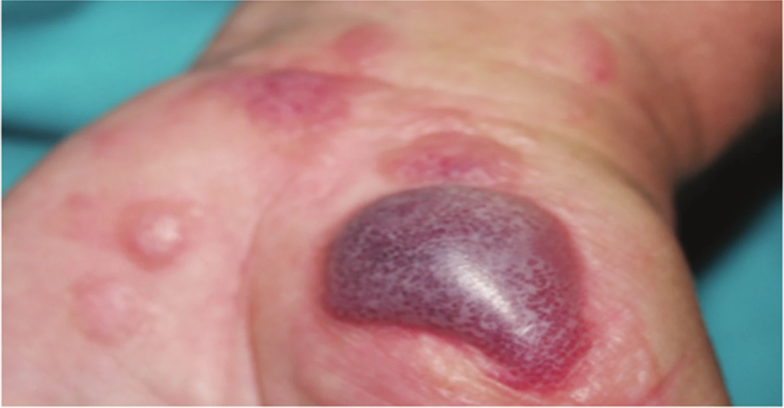 Akutní iritační kontaktní dermatitida s hemoragickými bulami po opakovaném umytí rukou 
v pracím prášku Colon