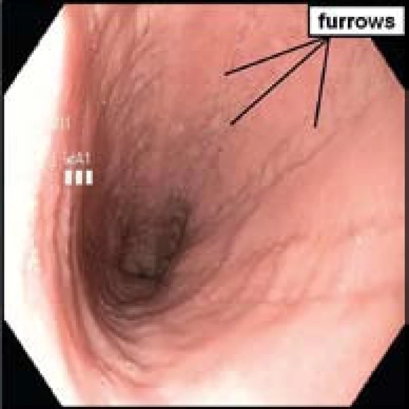 Endoskopický obraz typických podélných rýh (furrows) u pacienta s dg. EoE.
Fig. 4. Endoscopic image of typical longitudinal furrows in a patient with EoE.