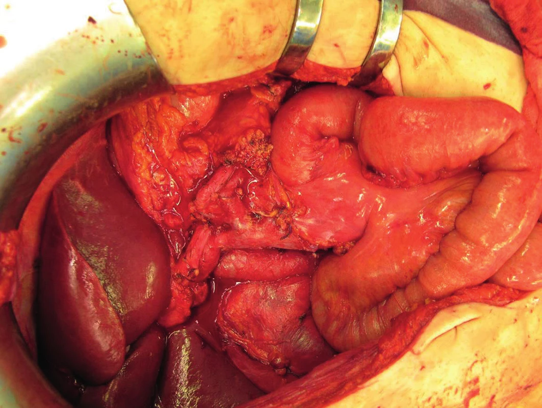 Stav po proximální pankreatoduodenektomii
Fig. 2. Status after proximal pancreaticoduodenectomy
