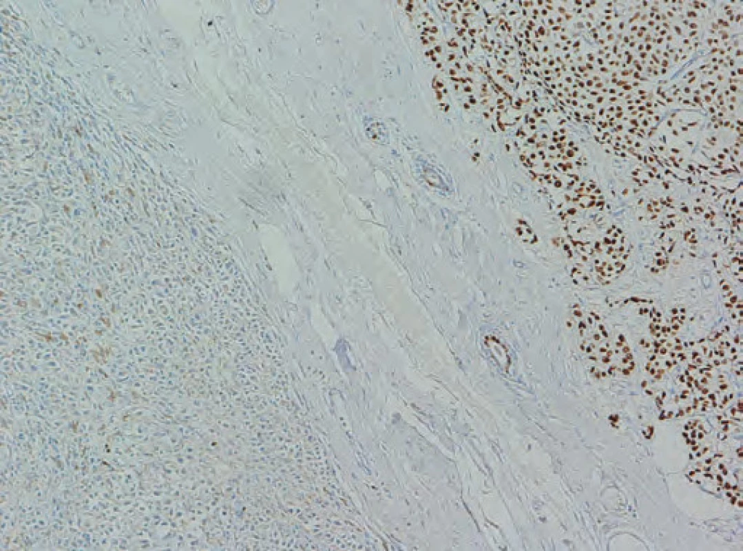 Pozitivita estrogenového receptoru v karcinomu (vpravo), negativita v melanomu (vlevo). Immunohistochemie ER (SP1), originální zvětšení 200x.