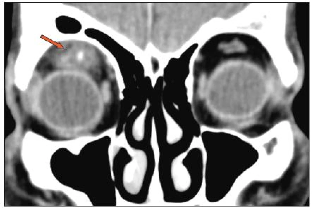 Kazuistika 2: CT orbit - zbytnění a prosáknutí m. rectus superior a měkkých tkání pod stropem levé orbity s tlakem na oční bulbus, s denzní pruhovitou strukturou uvnitř délky 2 cm, cizí těleso.
