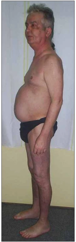 Typická faciotrunkální obezita s měsíčkovitým obličejem a hubenými končetinami u pacienta s rysy Cushingova syndromu.
