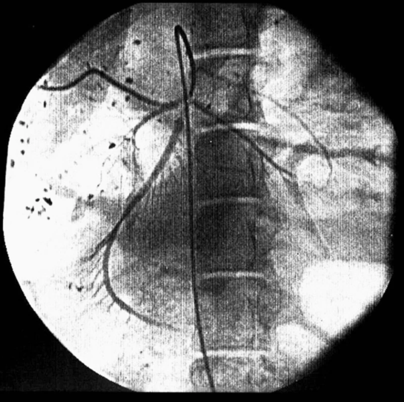 Angiografie periferní větve horní mezenterické tepny
Fig. 1. Angiography of peripheral branch of superior mesenteric artery