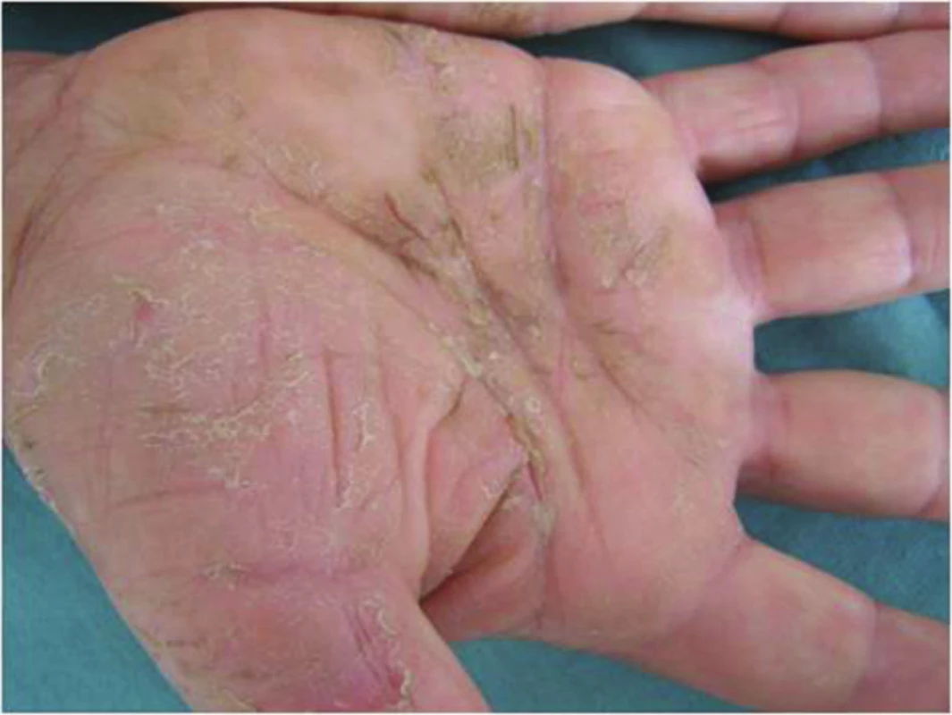 Chronická iritační kontaktní dermatitida na dlaních po pracovních rukavicích