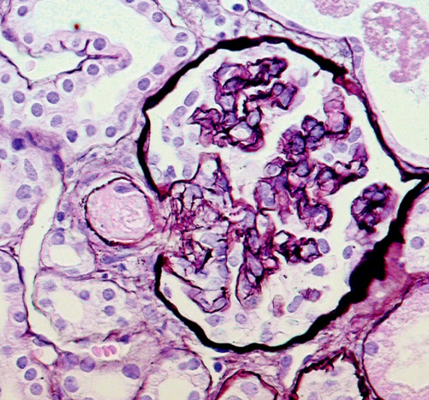Ischemicky kolabovaný glomerulus s trombotickým uzávěrem v přívodné arteriole (vas afferens)
(barvení PASM [periodic acid – silver methenamine]; objektiv 40krát) 
