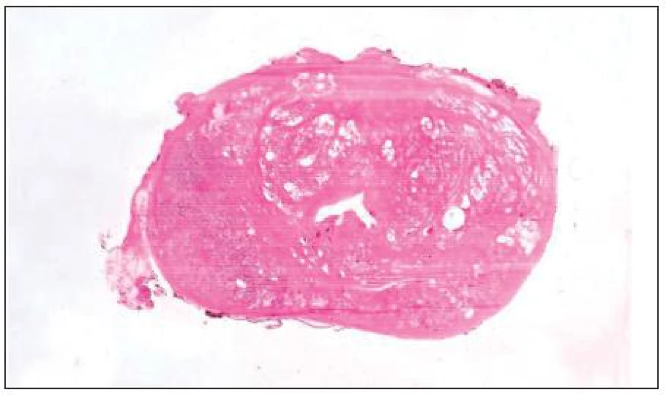 Na histotopogramu je dobře vidět nervově cévní svazek (vlevo)
Fig. 4. Neurovascular bundle is clearly visible in the left side of the histotogram