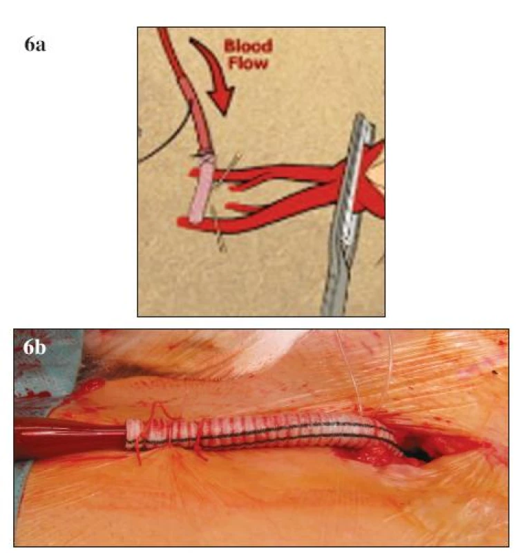 A, B. Neischemická kanylace femorální tepny (A – schéma, B – peroperační foto)
Fig. 6 A, B. Non-ischemic canylation of the femoral artery (A – diagram, B – intraoperative view)