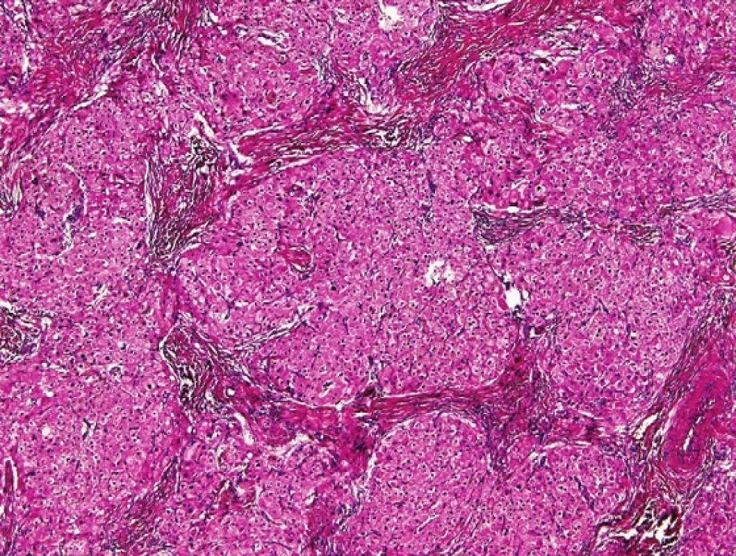 Na snímku je patrné, že „tumor“ u adrenogenitálního syndromu je lobulárně uspořádán a obsahuje nápadné fibrózní pruhy. HE, 200x