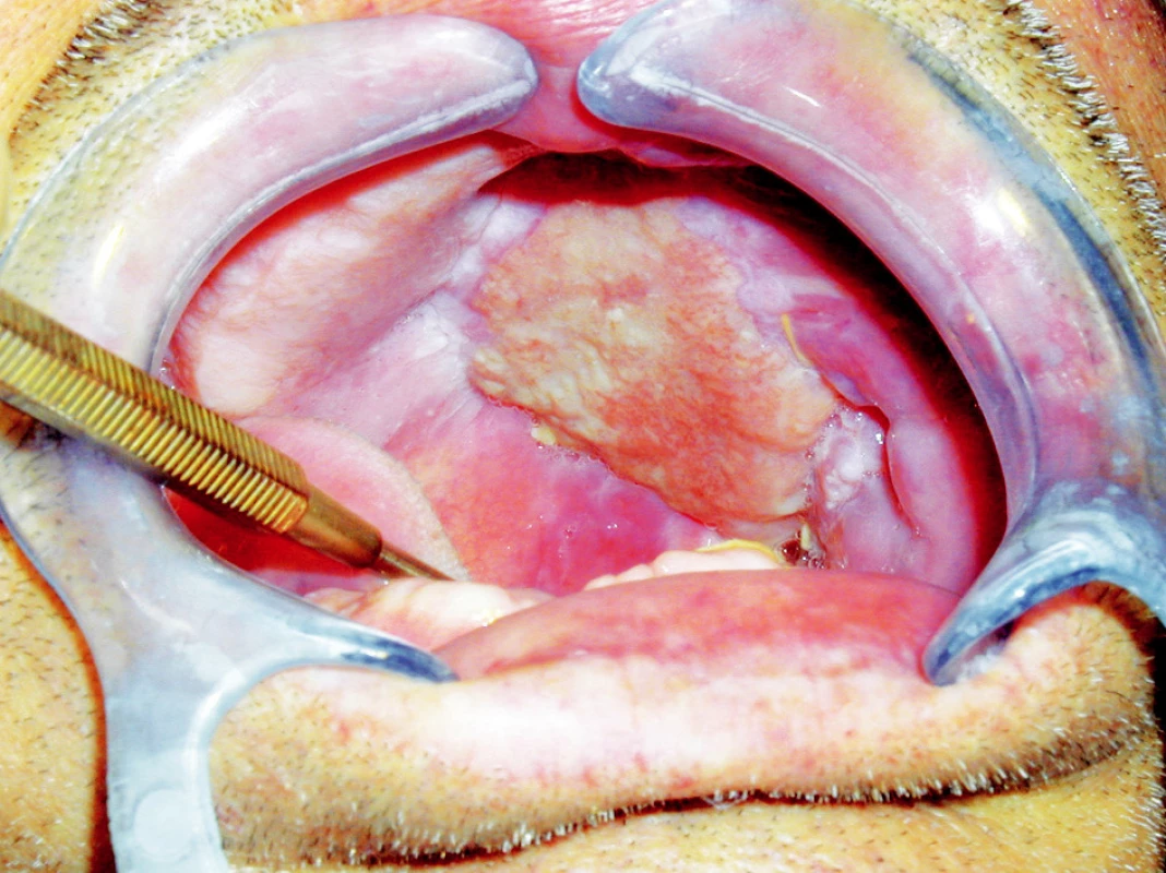 Temporální sval transponovaný do defektu po subtotální maxilektomii, probíhající epitelizace povrchu svalu. Stav 3 týdny po operaci