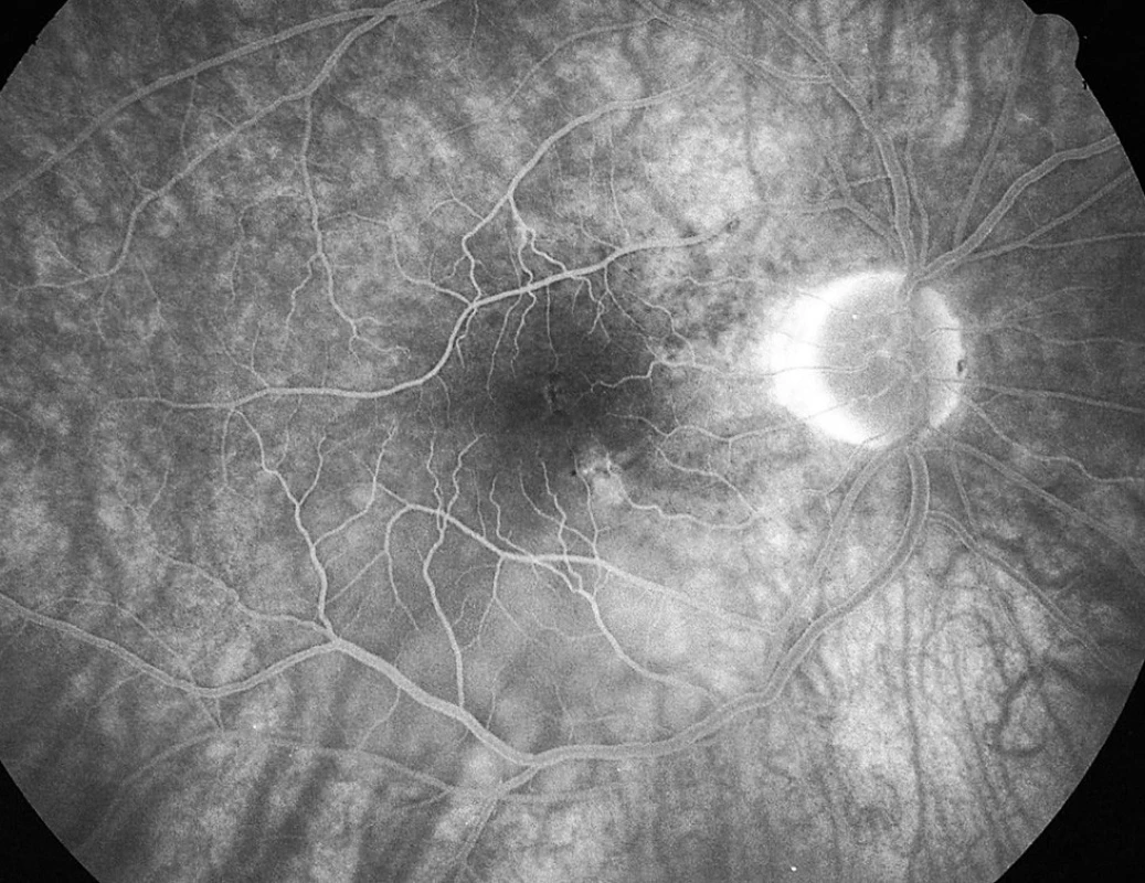 Pac. č. 5: Fluoresceínová angiografia PO po 2 týždňoch: jemné presakovanie pri č. 5 a 6, temporálne hore od TZN už len transmitujúca fluorescencia a pretrváva ablácia neuroepitelu retiny pod makulou okolo dolného temporálneho cievneho zväzku