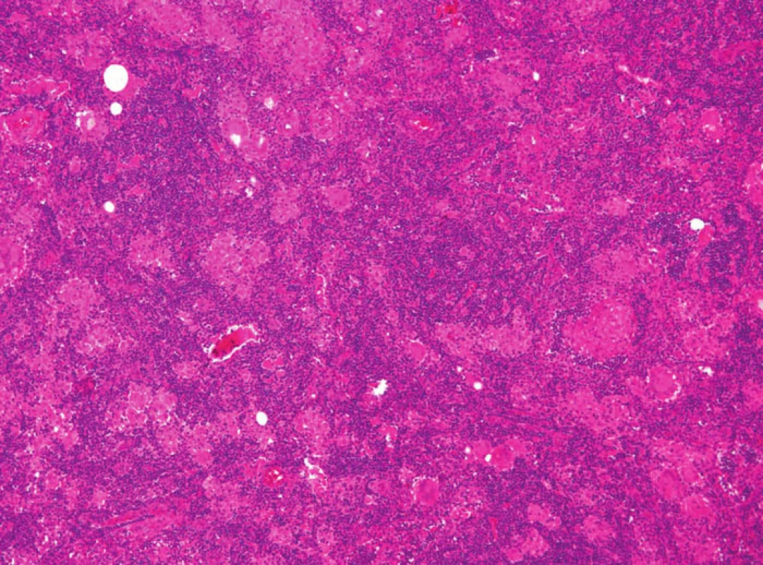Granulomatózní struktury s četnými obrovskými mnohojadernými buňkami.
Fig. 4: Granulomatous structures with multiple multinucleated cells