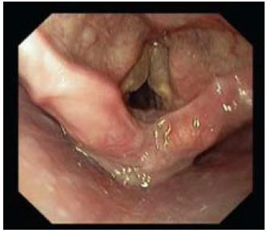 Reinkeho edém oboustranně.
Fig. 10. Reinke’s oedema of both vocal cords.