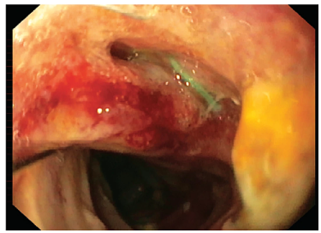 Endoskopický pohled na místo insuficience ezofagojejunoanastomózy, 10. pooperační den