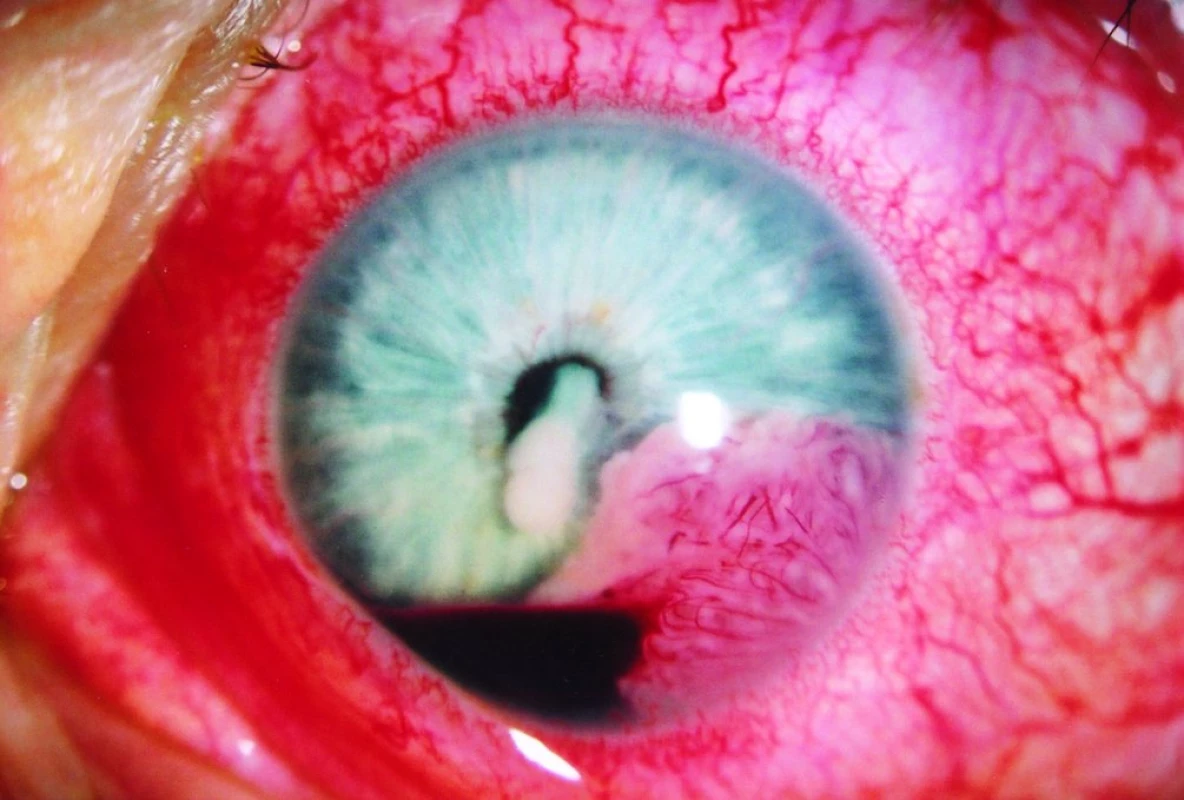 Progrese infiltrace s rozvojem krvácení do přední komory oční a tumorózními hmotami v zornici.