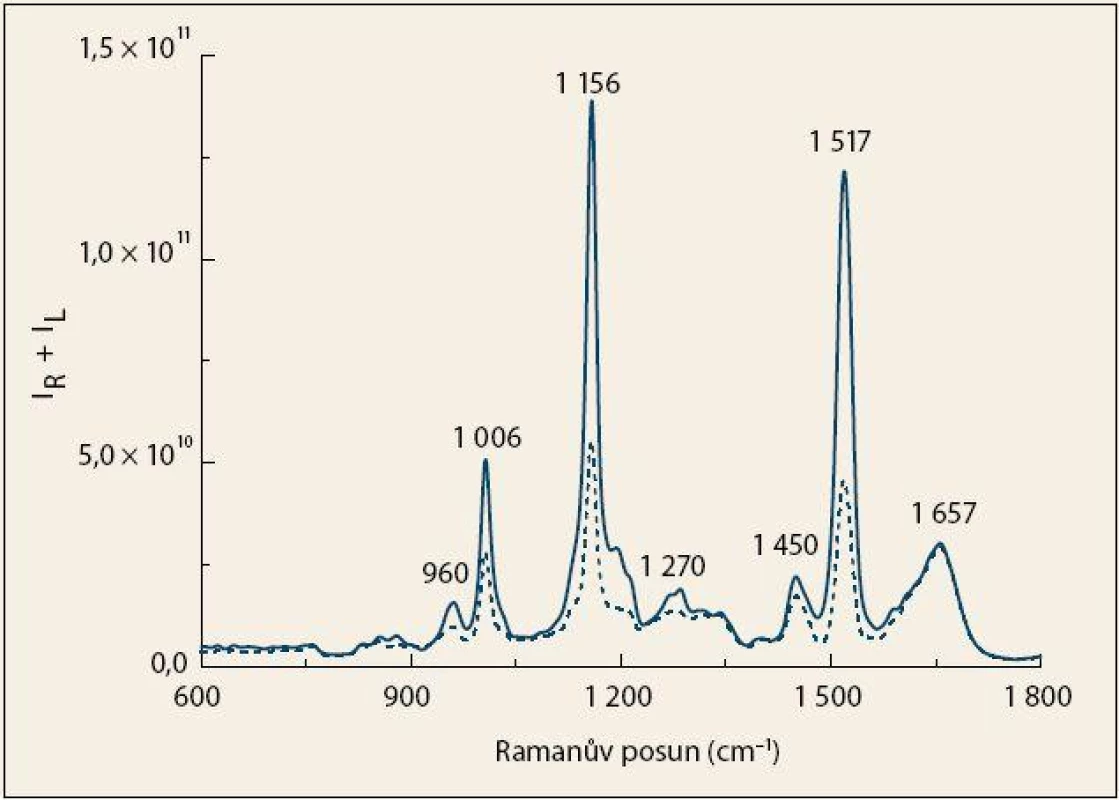 Průměrná Ramanova spektra krevní plazmy pacientů s karcinomem pankreatu (čárkovaná čára) a kontrolních jedinců (plná čára).
Fig. 1. The average Raman spectra of blood plasma from patients with pancreatic cancer (dashed line) and control subjects (solid line).