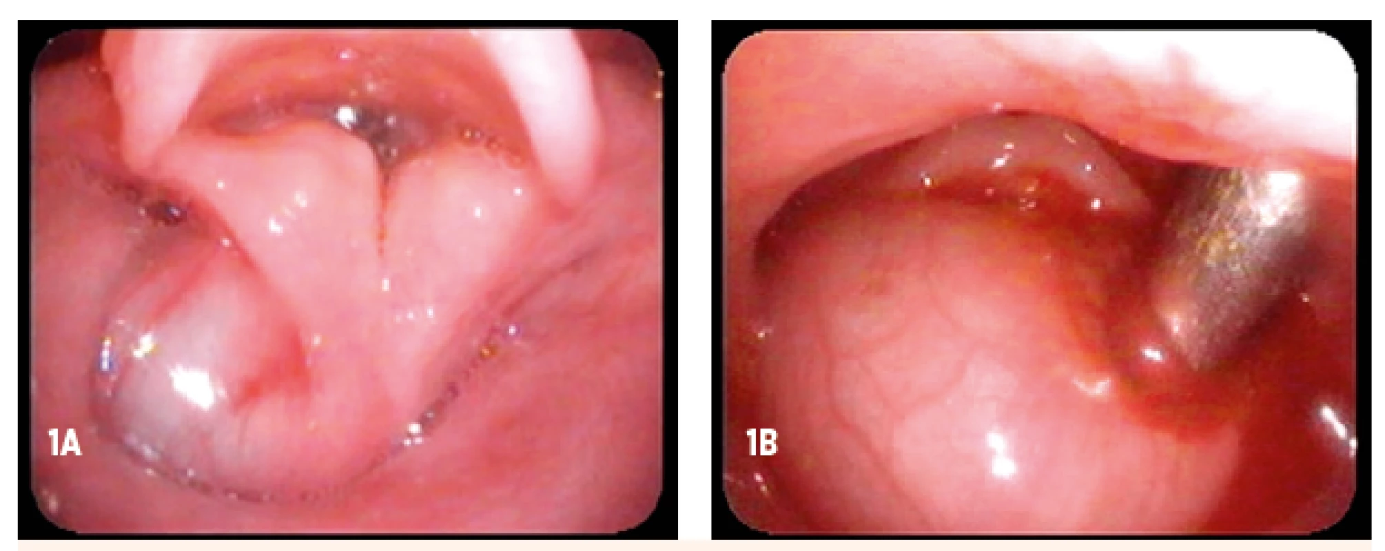 Cysta hrtana – peroperačný nález (vek dieťaťa 5 mesiacov). A – cysta z aryepiglotickej riasy vľavo, ktorá vypĺňa recessus piriformis vľavo, B – cysta obturujúca vchod do hrtana (po povytiahnutí)
Fig. 1. Laryngeal cyst – peroperative view (age of child 5 months). A – cyst of left aryepiglottic fold filling left piriform recess, B – cyst obturaiting supraglottic structures of larynx (after elevation)