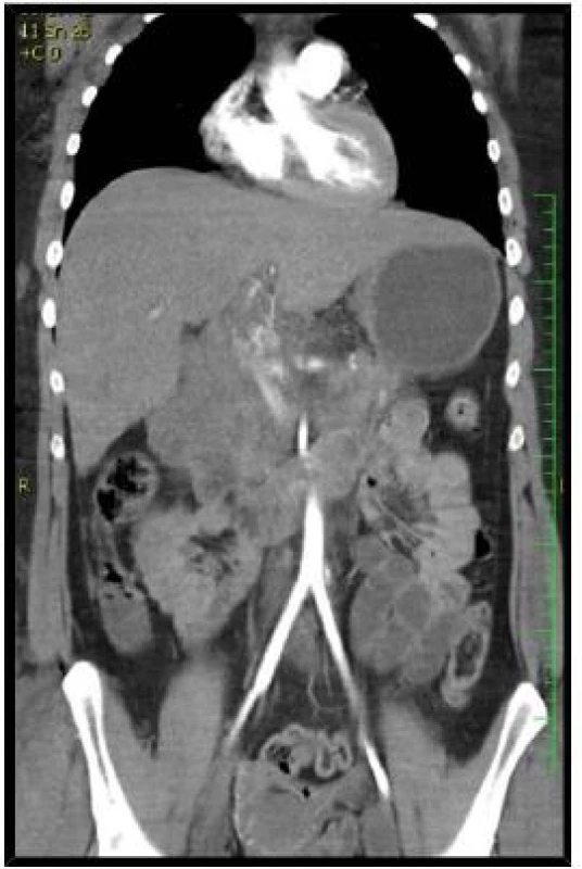 Angio CT snímky jater: Poranění jater IV. stupně s nálezem krvácení z poranění arteria hepatica propria