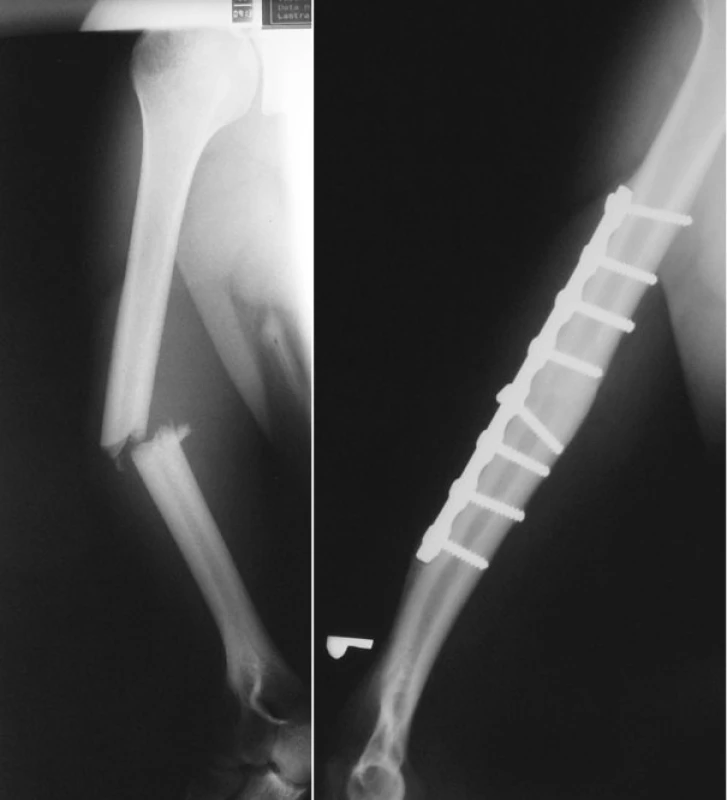 a. RTG obraz zlomeniny diafýzy pažní kosti 
Pic. 1a. X-ray picture of the humeral shaft fracture
b. RTG obraz zhojené zlomeniny diafýzy pažní kosti po ORIF (otevřené repozici a dlahové osteosyntéze)
Pic. 1b. X-ray picture of the healed humeral shaft fracture after ORIF

