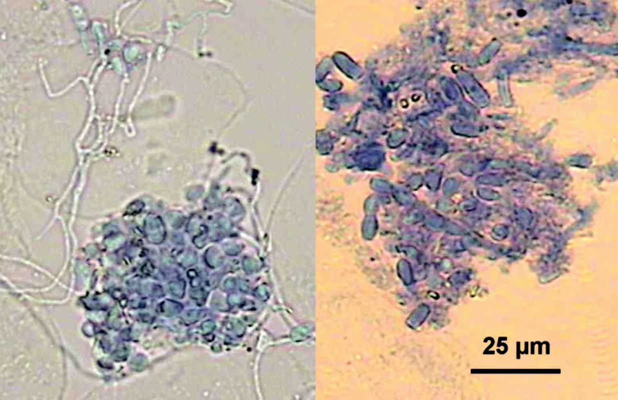 Hýfy a zhluky súdkovitých artrokonídií O. canadensis vo vzorkách nechtov (mikroskopicky, v KOH s Parker black ink) (foto A.V.).
