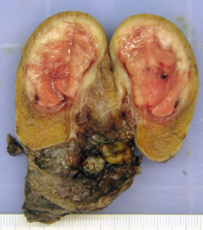 Preparát levého varlete s ložiskově prokrváceným tumorem (foto Radim Žalud)
Fig. 2. Left testis with tumour – section (photo Radim Žalud)