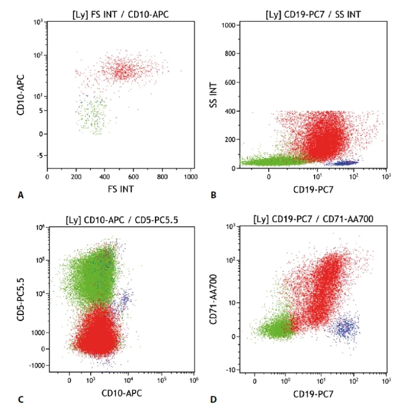 Difuzní velkobuněčný lymfom. Průtoková cytometrie. Gate na lymfocyty. Buňky DLBCL červeně, ostatní B lymfocyty modře, T lymfocyty a NK buňky zeleně. A - DLBCL s pozitivní expresí CD10 větší velikostí buněk (parametr „FS INT“ na ose x), B - DLBCL se sníženou expresí CD19 oproti benigním B lymfocytům, nápadná vyšší granularita buněk (parametr „SS INT“ na ose y), C - DLBCL s negativní expresí CD5 i CD10, D - DLBCL s částečnou pozitivitou CD71.