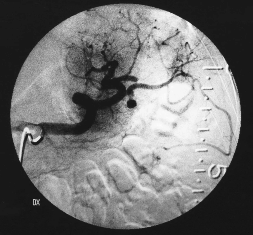Selektívna angiografia arteria lienalis s drobnou vakovitou aneuryzmou s priemerom 5 mm s úzkym krčkom
Fig. 2. Selective angiography of arteria lienalis, with a minor sac-like aneurysm, 5mm in a diameter, with a narrow neck