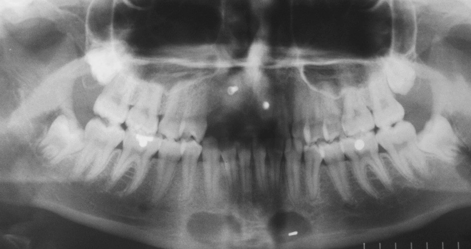 RTG po augmentaci. V bradové části mandibuly jsou zřetelná odběrová místa kostních štěpů.V levém odběrovém místě byla zalomena špička kostního vrtáku. Nebyla nalezena.