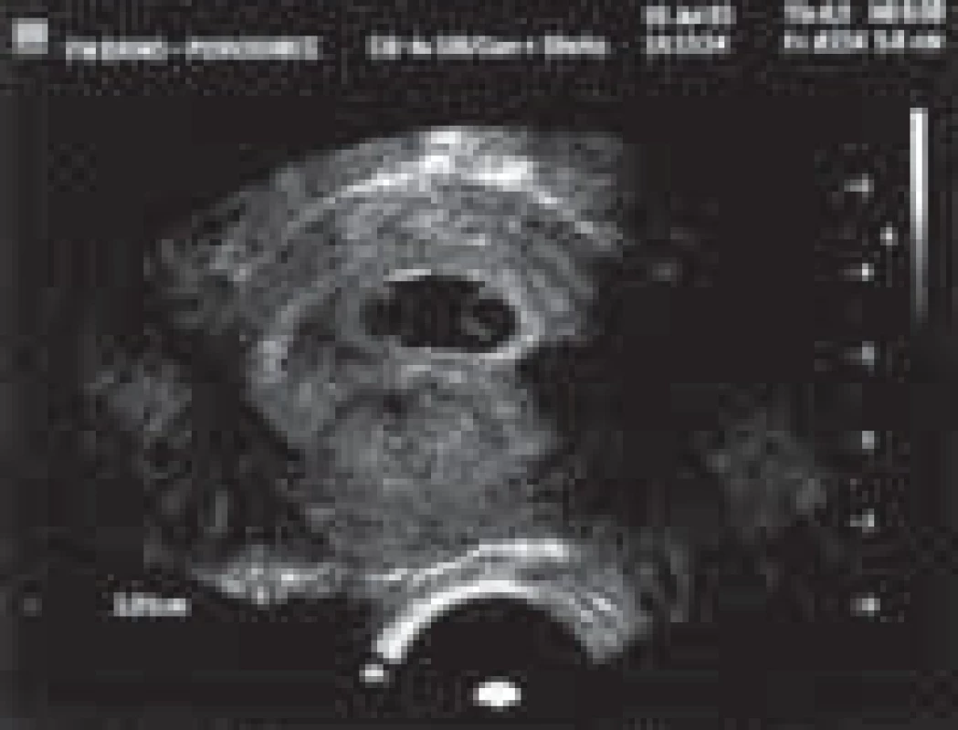 Monochoriální gravidita – časné stadium gravidity, kdy je na ultrazvuku patrný jeden gestační váček, dva žloutkové váčky, amniální přepážka t. č. není patrná.