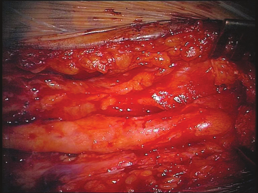 Stav po exstirpaci Bakerovy cysty
Fig. 4. Condition following extirpation of the Baker’s cyst
