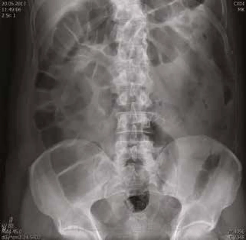 Nativní RTG snímek břicha: výrazná distenze celého tračníku