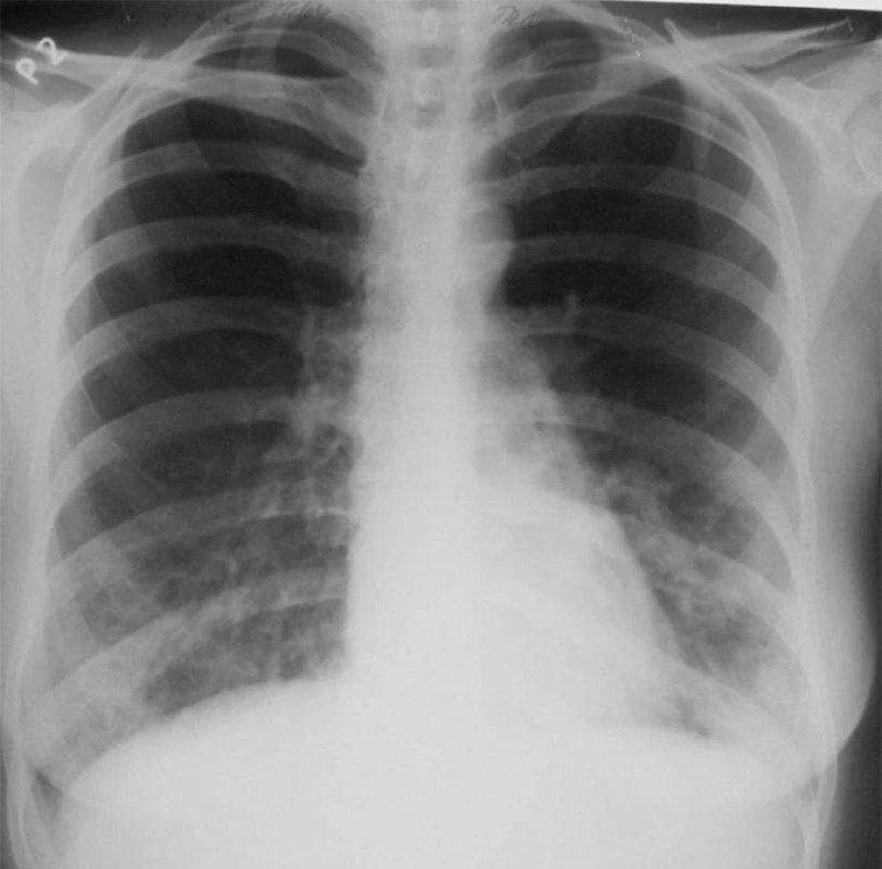 Primární infekce Chlamydií pneumoniae u mladé pacientky – diseminace drobných, střednû sytých stínů v dolních třetinách obou plicních polí.