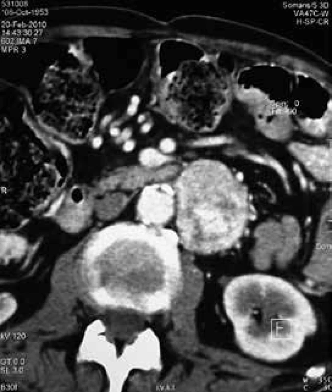 CT vyšetrenie abdomenu pri diagnostike