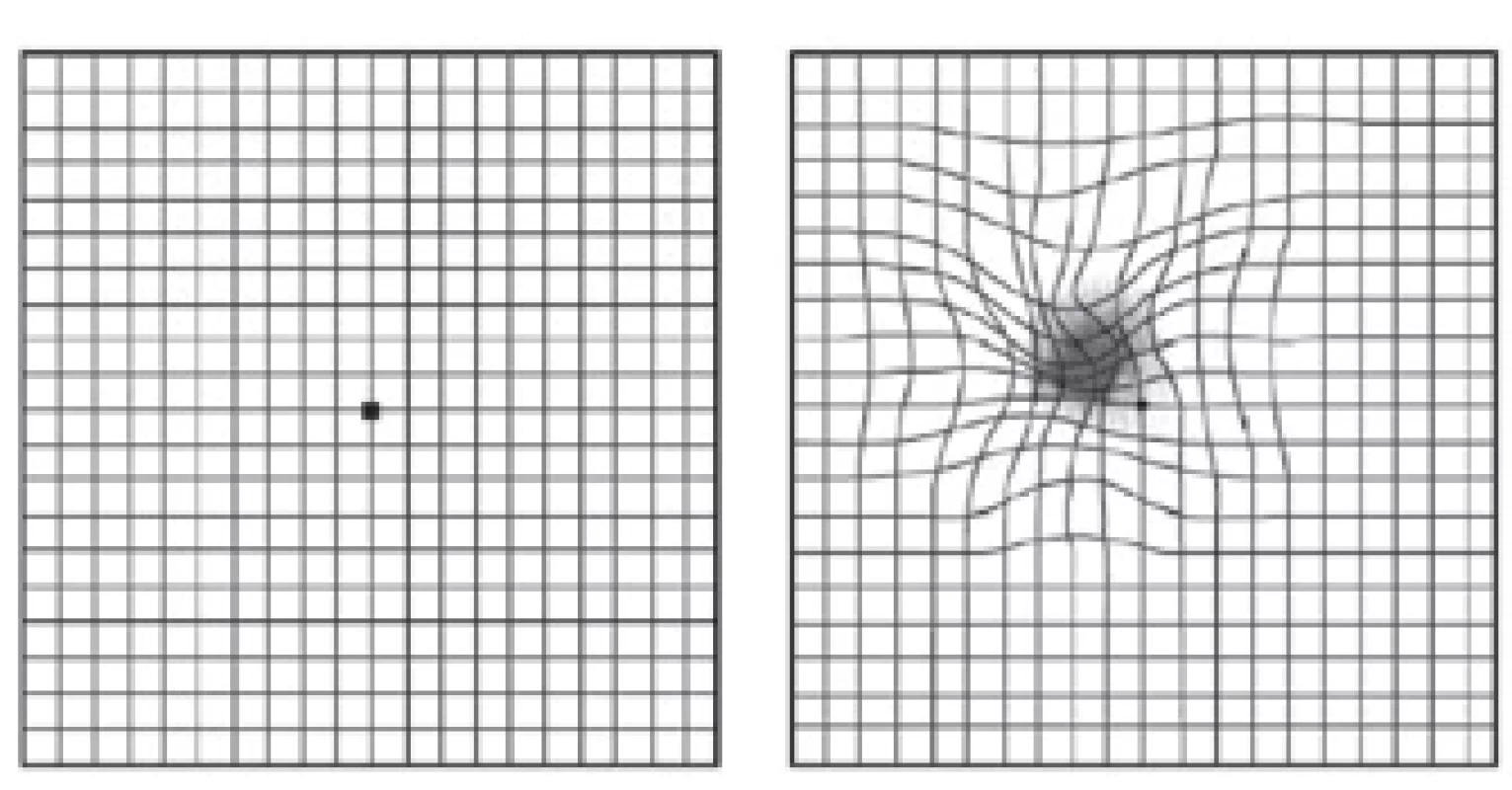 Amslerova mřížka. Vlevo normální vidění, vpravo vidění s vlhkou formou věkem podmíněné makulární degenerace(15)