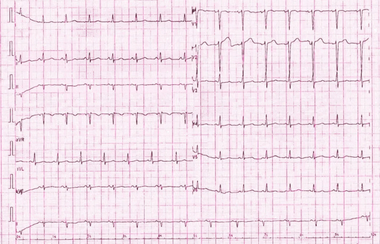 EKG u pacientky 3. den po porodu před propuštěním z Interní kardiologické kliniky: fyziologická křivka sinusového rytmu, TF 85/ min s normálními převodními parametry (PQ 0,14 ms, QRS 0,08 ms), osa 0°, přechodová zóna V3, zcela bez komorových arytmií.