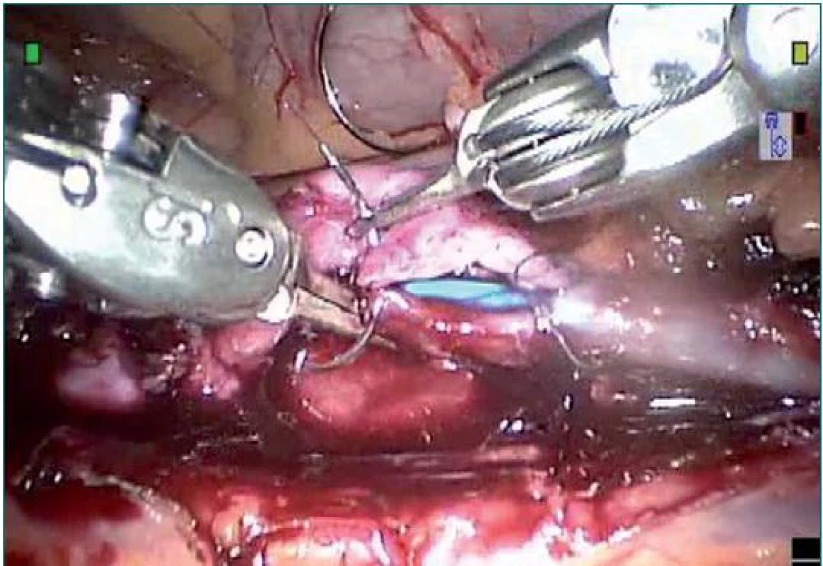 Ureteroureterostomie močovodu horního pólu k močovodu dolního pólu provedená pomocí 6-0 monofilamentózní vstřebatelné sutury.