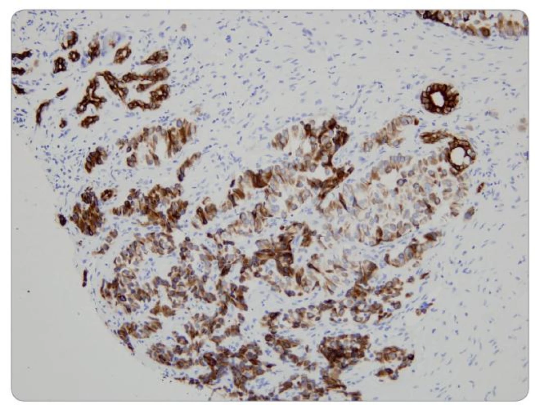 Neuroendokrinní nádor pankreatu – FNAB (cytokeratin).