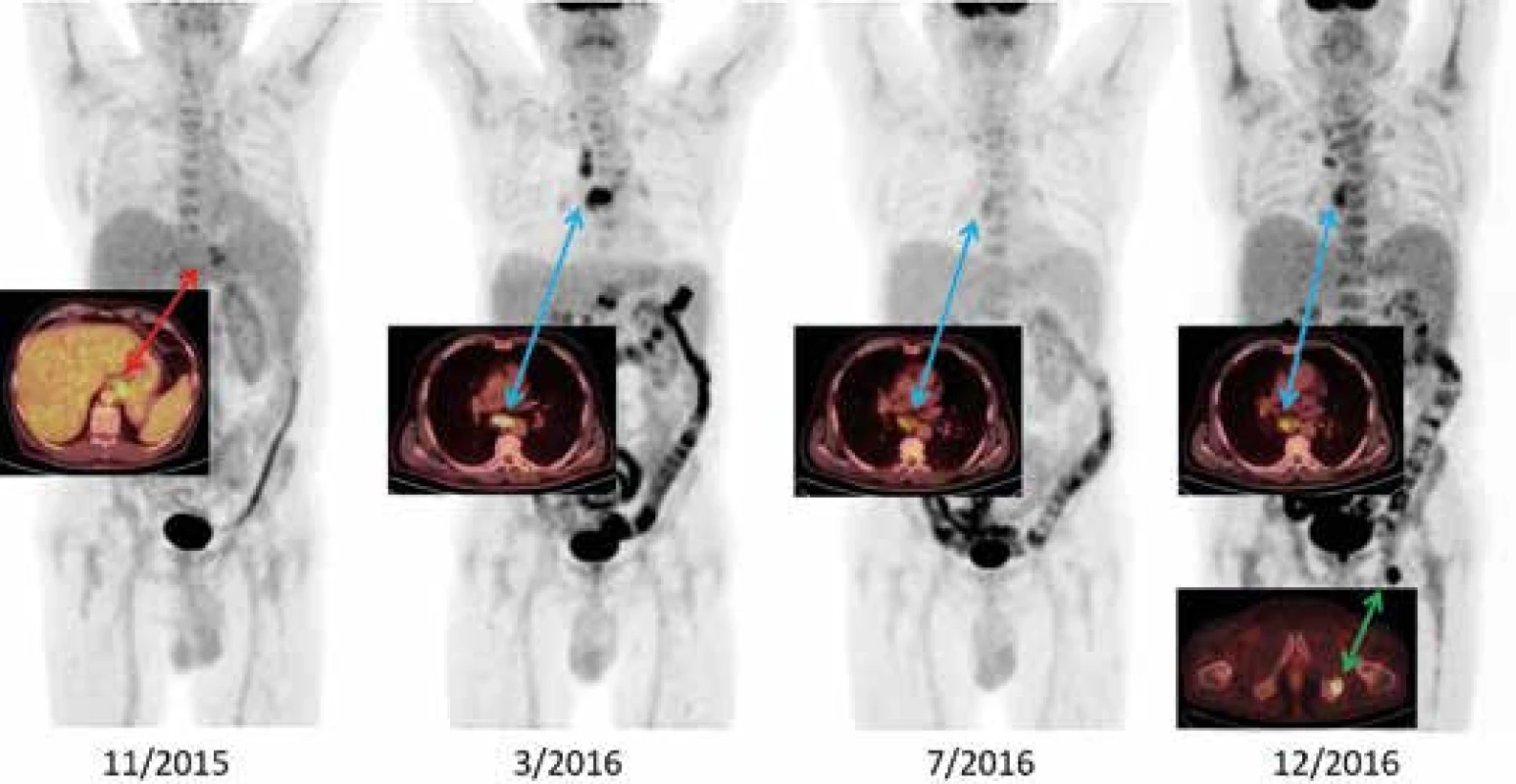 Vývoj nemoci v FDG-PET/CT obraze