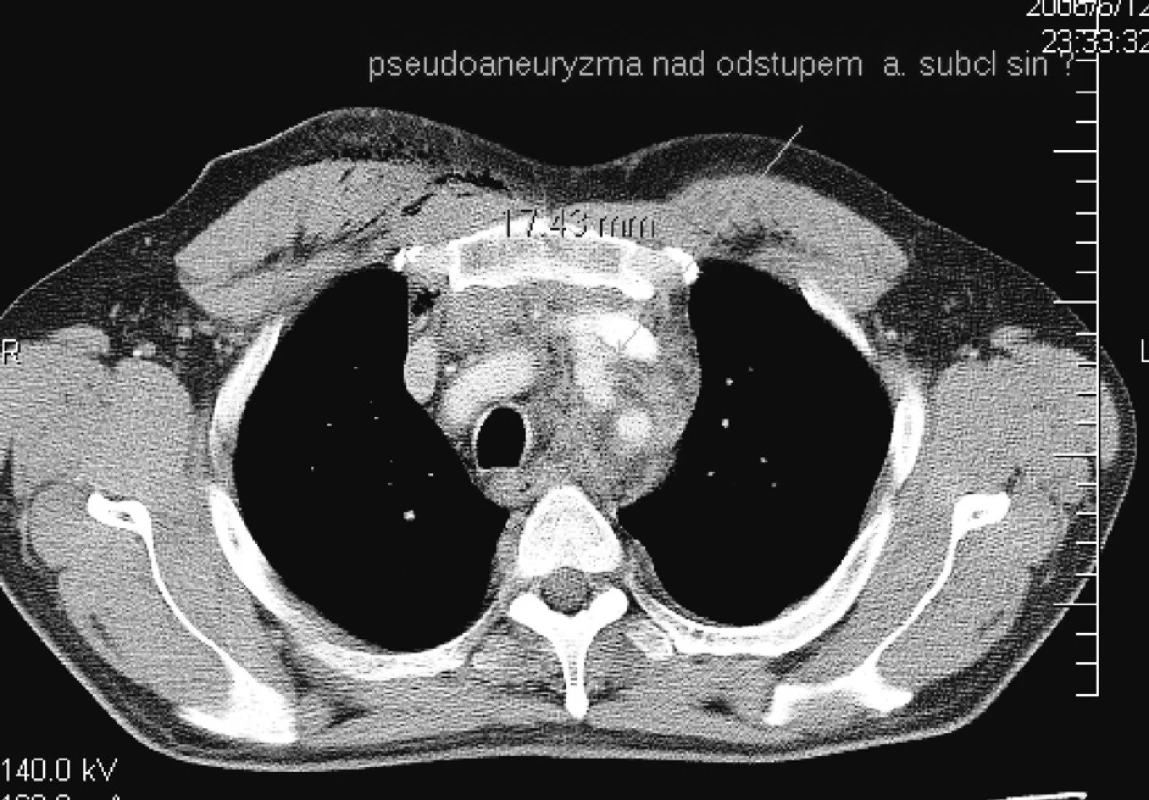 CT nález – Pseudoaneuryzma pri neúplnej lézii steny ľavej karotickej tepny
Pic. 3. CT finding – A pseudoaneurysm in incomplete lesion of the right carotid arterial wall