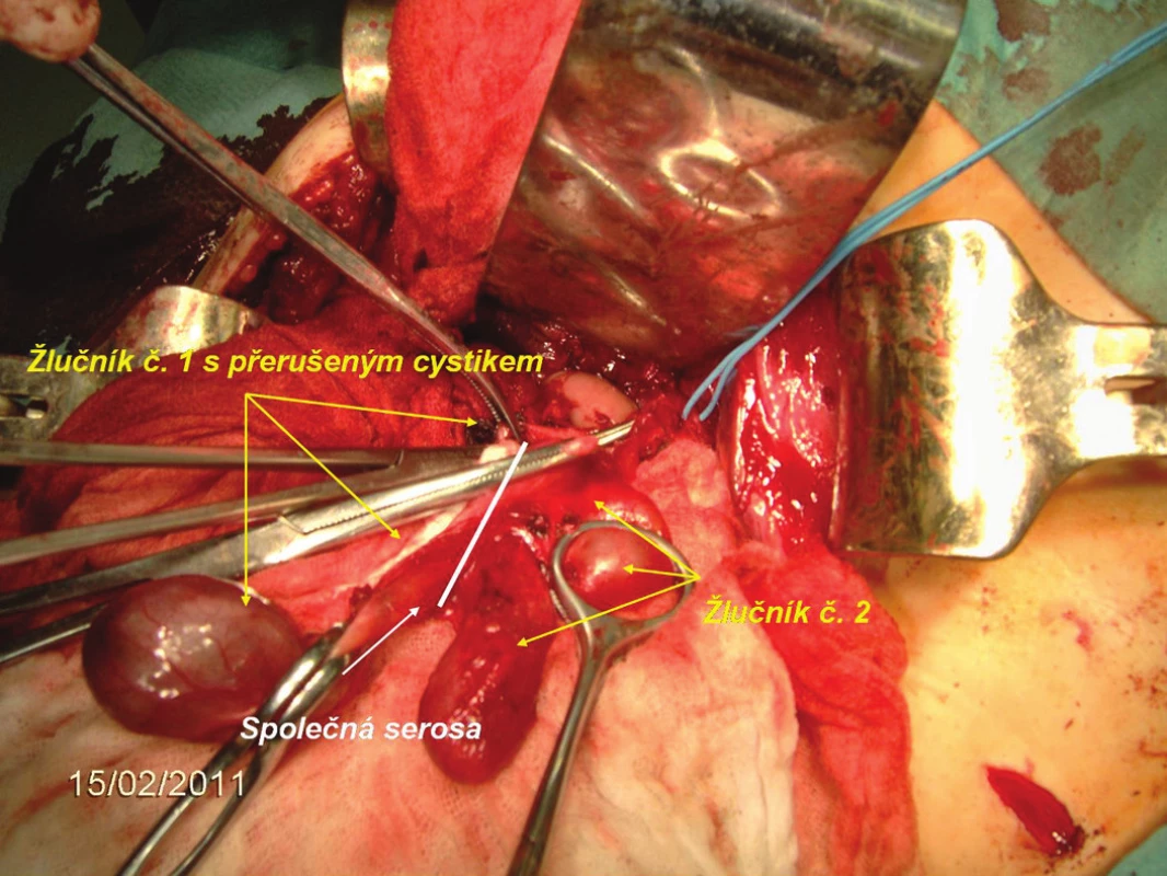 Peroperační nález dvojitého žlučníku
Fig. 3: Peroperative finding of a double gallbladder

