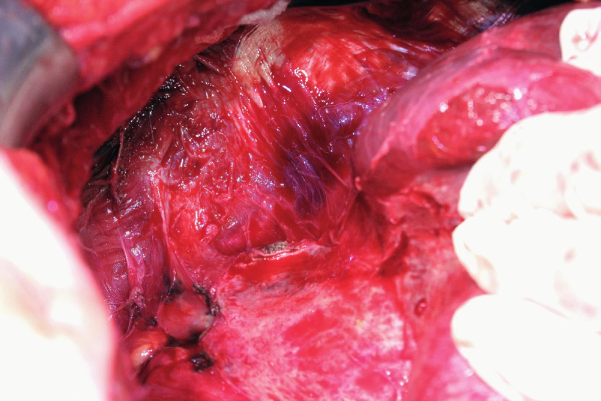 Mediální rotace pravého laloku jater, stav po peritonektomii
